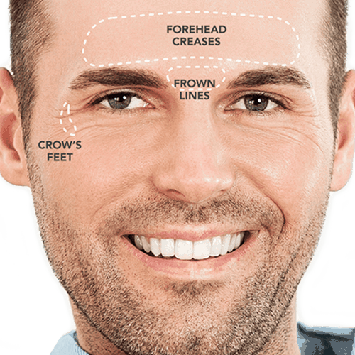 Brotox - Botox for men in Pittsburgh
